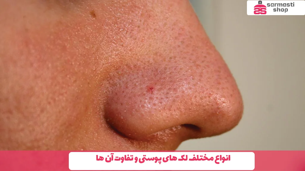 انواع مختلف لک ‌های پوستی و تفاوت آن‌ ها 