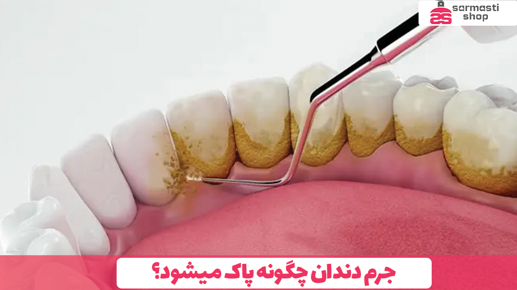 جرم دندان چگونه پاک میشود؟