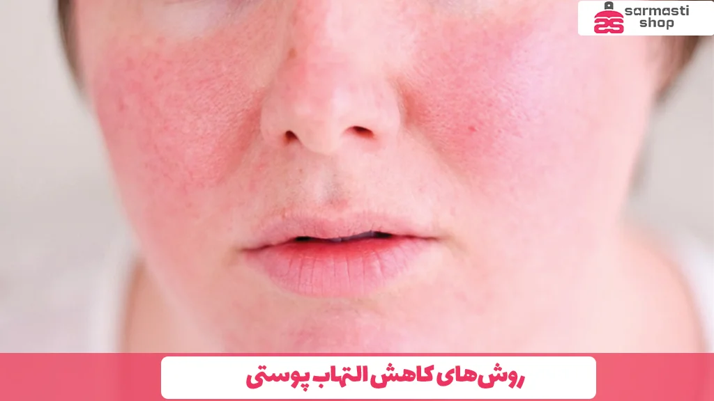 روشهای کاهش التهاب پوستی